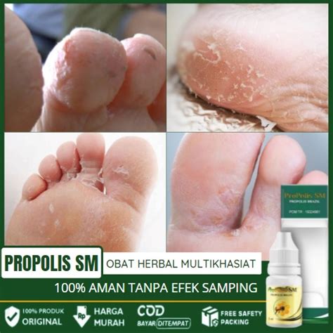 Jual Obat Kaki Mengelupas Dan Gatal Kulit Telapak Kaki Jari Kaki Kuku