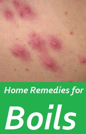 10 Most Effective Home Remedies To Treat Heat Boils On Skin Home