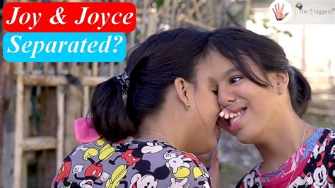 Conjoined Twins Joy And Joyce Magsino Separated Body Bizarre YouTube