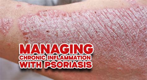 Managing Chronic Inflammation With Psoriasis Mega Doctor News