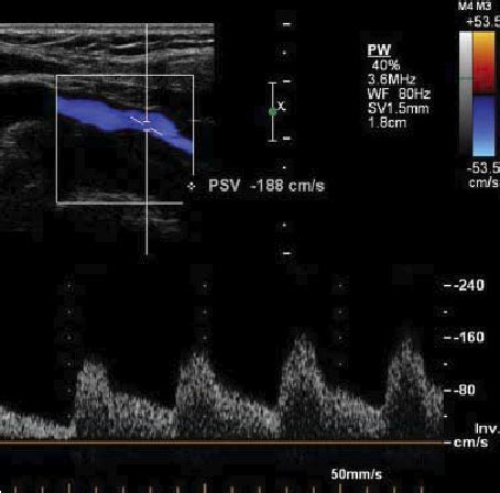 Carotid Duplex Ultrasonography Of The Right Internal Carotid Artery