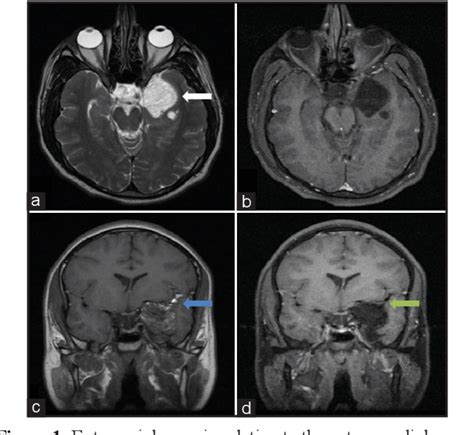 Figure 1 From Ruptured Intracranial Dermoid Cyst Semantic Scholar