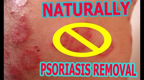 How To Cure Treat Psoriasis Naturally Permanently Stop Itching And