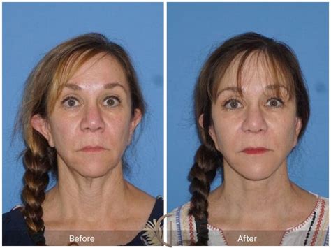 Facelift Fifties Before And After Photos Patient 80 Dr Kevin Sadati