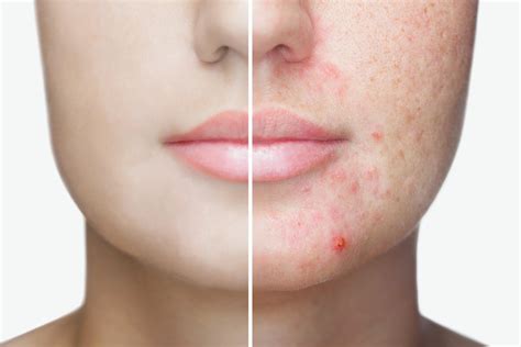 Treatments You May Not Know About For Acne Dermatology Associates