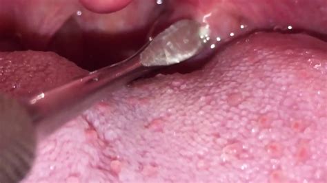 Tonsil Stone Removal 7 Youtube
