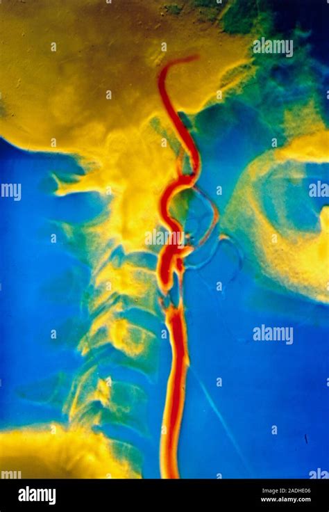 False Colour Angiogram Arteriogram Of The Human Neck Showing A Major