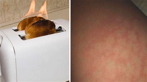Hautausschlag Durch Laptop Toasted Skin Syndrom Im Homeoffice