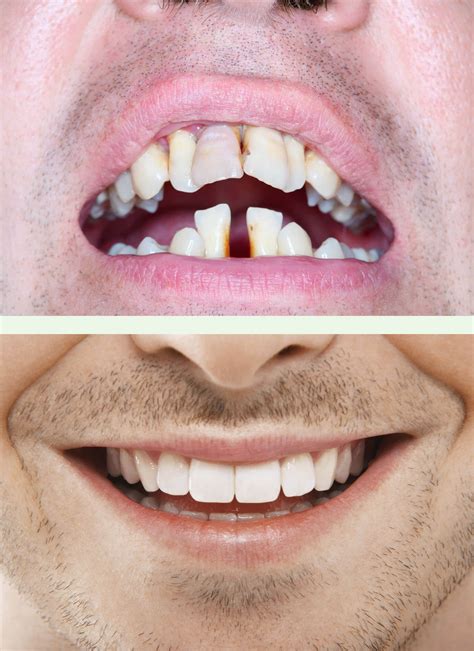 The care smile® smart toothbrush combines accessibility, precision, technology and efficiency. How do I fix my 'Twisted', Discoloured smile? Chatswood ...