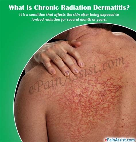 Chronic Radiation Dermatitiscausessymptomstreatmentrisk Factors
