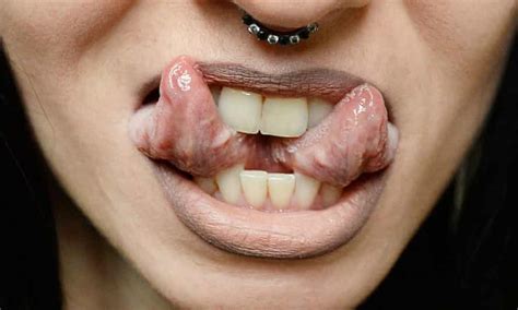Tongue Splitting Poses Serious Risk To Health Say Surgeons Dentists