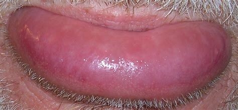 Inflamed Lips Pictures Photos