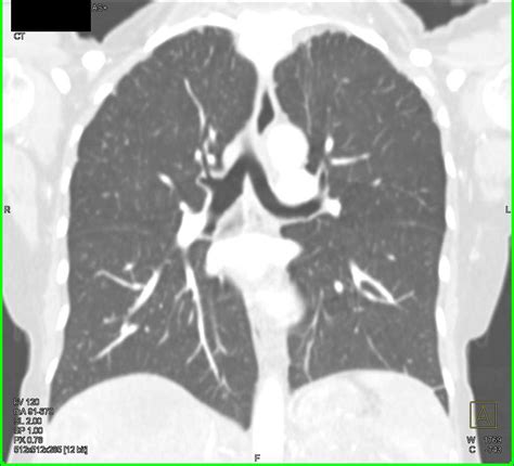 Left Upper Quadrant Sarcoma With Extensive Metastases Liver Case