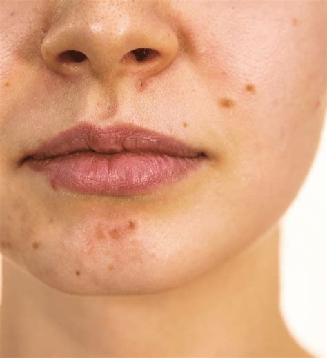 Skin Tags And Blemishes Removal Before And After Photos Perfect Skin