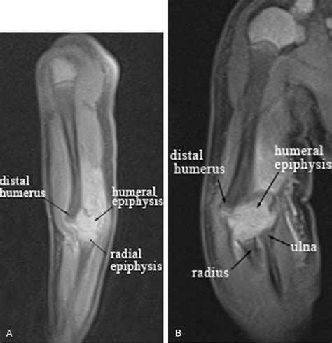 Figure 2 From Neonatal Distal Humeral Physeal Separation During