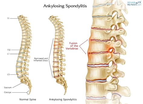 Ankylosing Spondylitis As Rehab My Patient