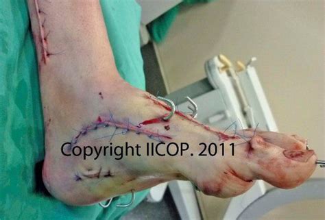 125 best Living with Charcot-Marie-Tooth Disease images on ...