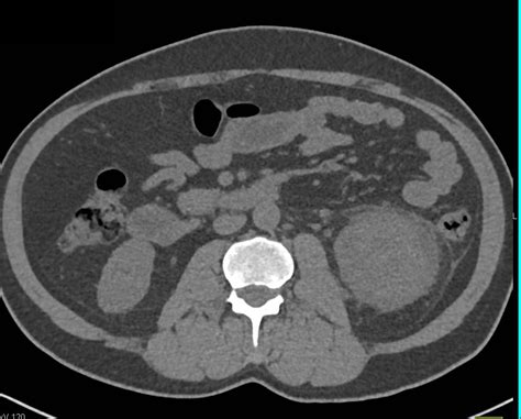 Acute Pyelonephritis With Abscess Kidney Case Studies Ctisus Ct