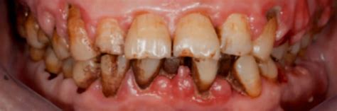 Chronic Vs Aggressive Periodontal Disease Dental Negligence Team
