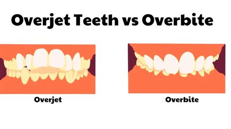 Overjet Teeth Vs Overbite Whats Different Spring Orchid Dental