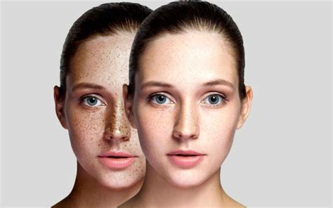 How To Remove Freckles Fast With Laser Treatment Expert Centre
