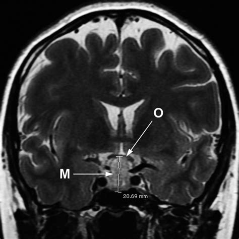 t1‐mri pituitary sagittal scan at 2 wk postpartum macroadenoma m download scientific diagram