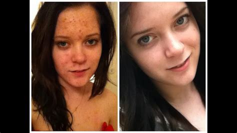 My Accutane Journey Before After Pictures Youtube