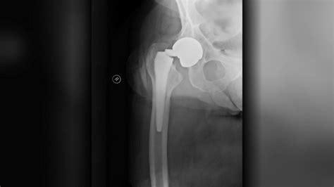 Watch Cbs Mornings Faulty Hip Implants Took Years To Be Recalled Full Show On Cbs