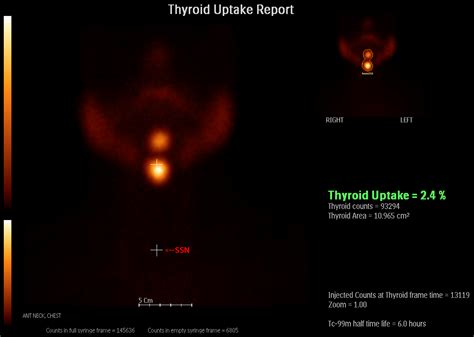 Ectopic Thyroid Image