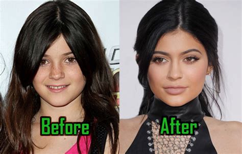 Kylie Jenner Plastic Surgery Transforms Her Look Surprising Before