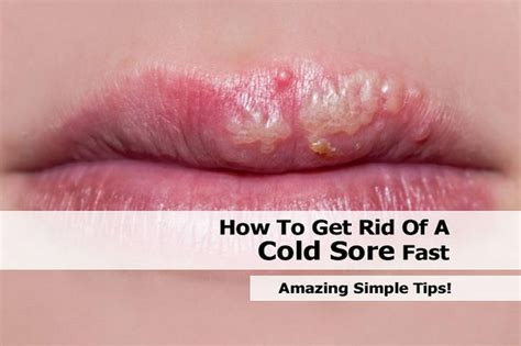 How To Get Rid Of A Cold Sore Fast