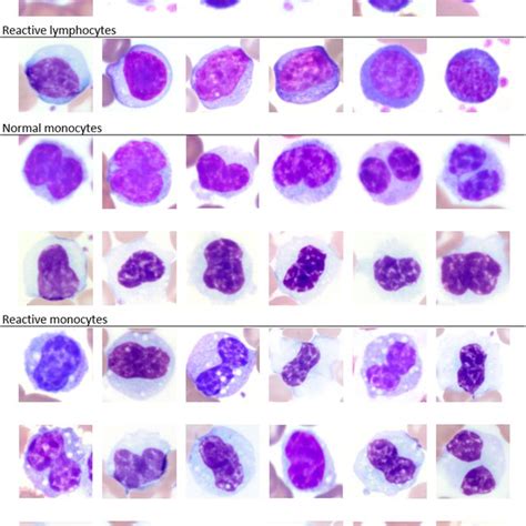 Image Composite Of Normal And Reactive Lymphocytes And Monocytes Hot