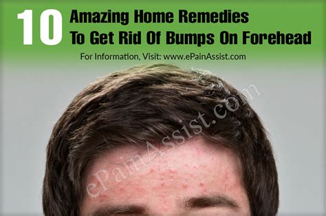 10 Amazing Home Remedies To Get Rid Of Bumps On Forehead