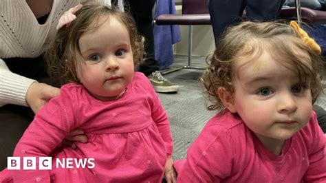 Conjoined Twins Defying The Odds To Survive London