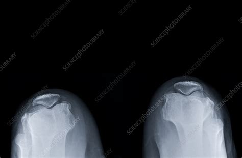 Healthy Knees X Ray Stock Image F0375541 Science Photo Library