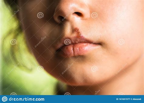 Herpes On Upper Lip Of Little Girl Child With Cold Sores On Her Lips