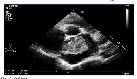 Figure 2 From Multiple Giant Left Atrial Thrombi In Mitral Stenosis