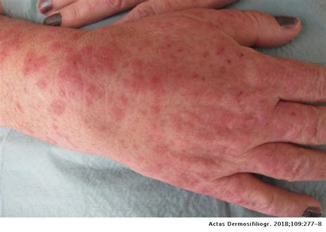 Erythema Multiforme Caused By Treatment With Topical Imiquimod 5 In A