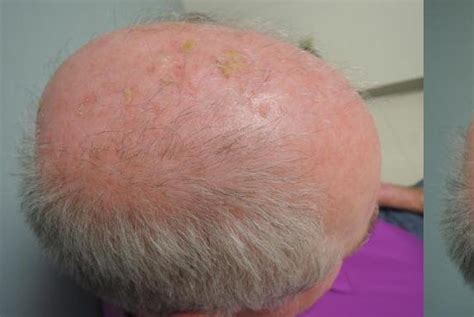 Topical Treatment Shown To Clear Precancerous Skin Lesions