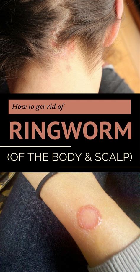 How To Get Rid Of Ringworm Of The Body And Scalp Get Rid Of