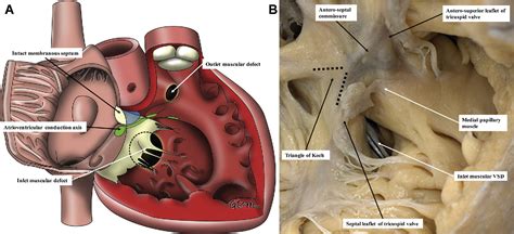 Figure From Classification Of Ventricular Septal Defects For The Eleventh Iteration Of The