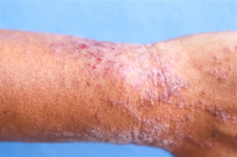 The 6 Most Common Skin Rash Types Page 6 Of 6 Healthvibe