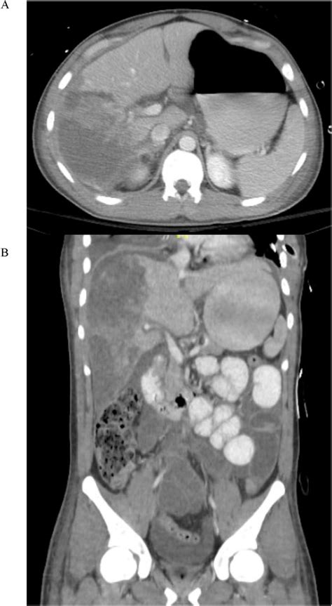 Axial A And Coronal B Abdominal Ct Scans Demonstrating Aast Grade 5