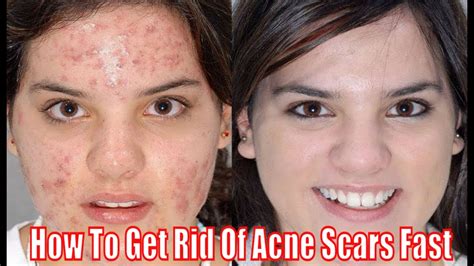 How To Get Rid Of Acne Scars Fast Using Natural Remedies Youtube