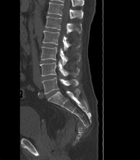 Coccygeal Fracture Neurorad911 Coccygeal Fracture