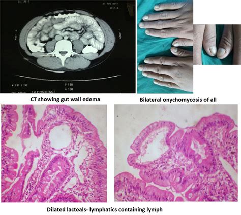 Iddf2018 Abs 0262 Primary Intestinal Lymphangiectasia In Young Adult