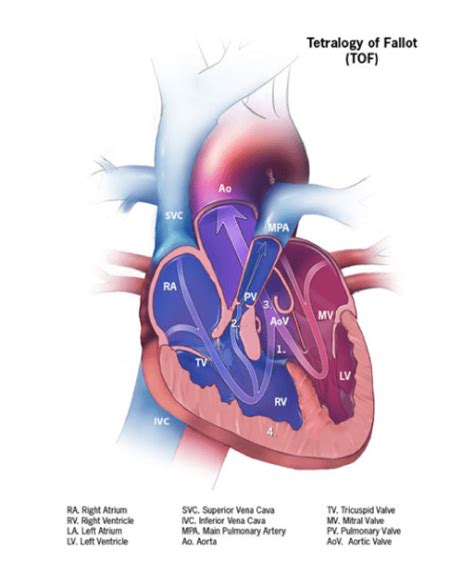 About Tetralogy Of Fallot Hope For Hearts Australia