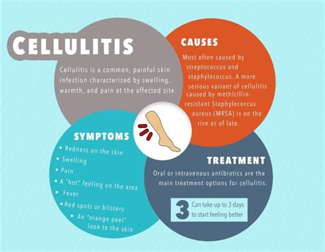 Cellulitis Treatment Antibiotics