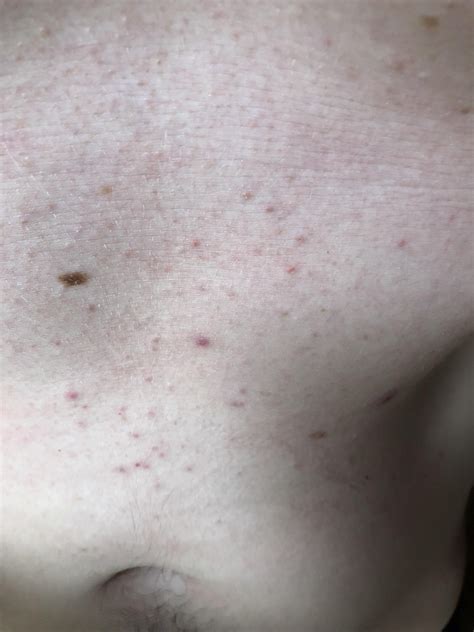 32m Is This Acne Stomach Photo Of Bumps That Have Been Around For