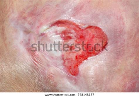 Pressure Injury Images Search Images On Everypixel